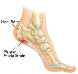 Heel Pain in 11 Year-Old Girl {{brizy_dc_image_alt imageSrc=