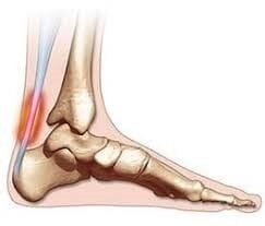 achilles tendon pain {{brizy_dc_image_alt imageSrc=