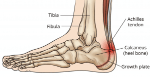 Pain in the Back of the Heel