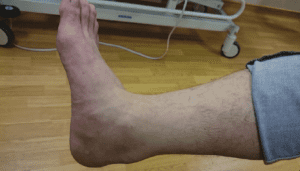 back of the heel due to Achilles tendonitis