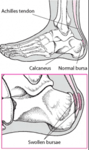 Achilles Tendonitis