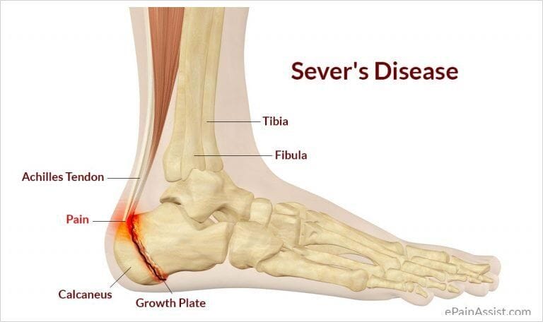 Sever's Disease