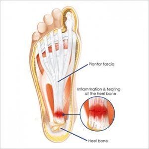 Inflamation and tearing at the heel bone.. a schematic diagram explaining what is plantar fasciitis