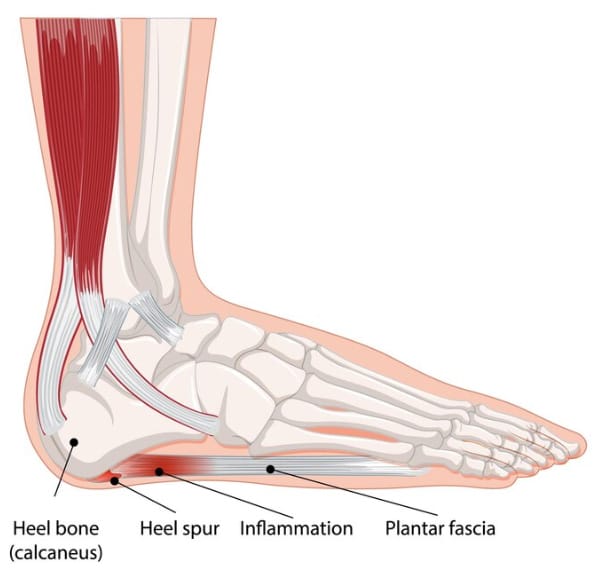 PLANTAR FASCIITIS treatment