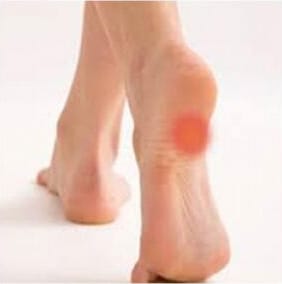 Plantar Fasciitis location under the foot