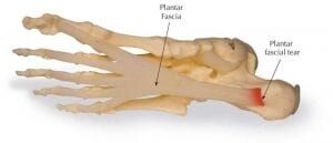 Severe Plantar Fasciitis