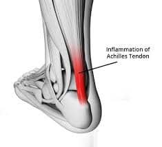 Achilles Tendonitis