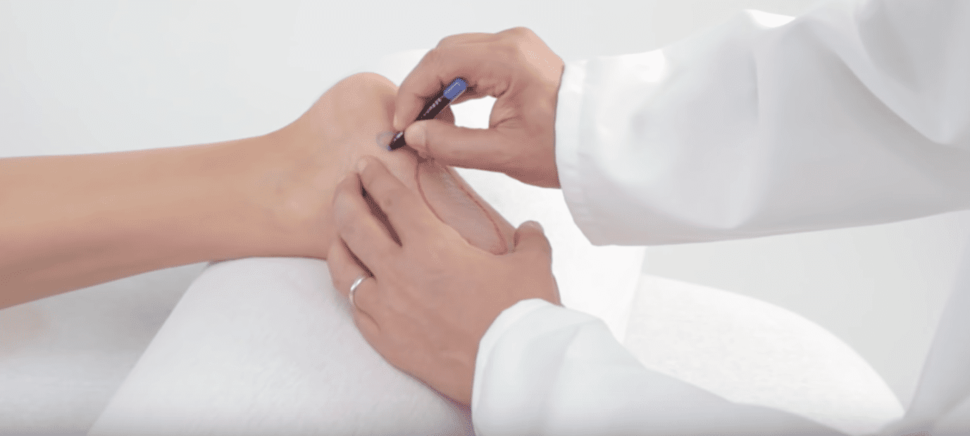 Swiss Dolorclast machine for shock wave therapy