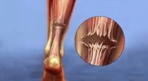 Achilles Tendon Rupture